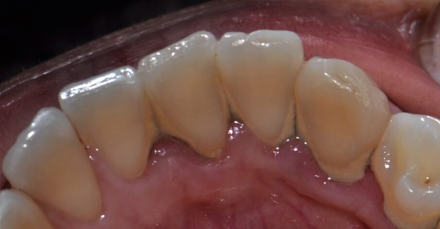 Fig 4: incisal wear of 41, 42,& 43