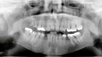 Met QuickSleeper bleef patiënt rustig