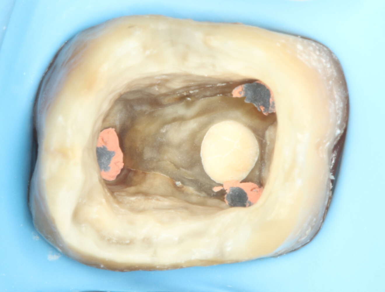 Fig. 26 : Matériau biocéramique scellant la zone perforée avant la reconstruction préprothétique de la dent.