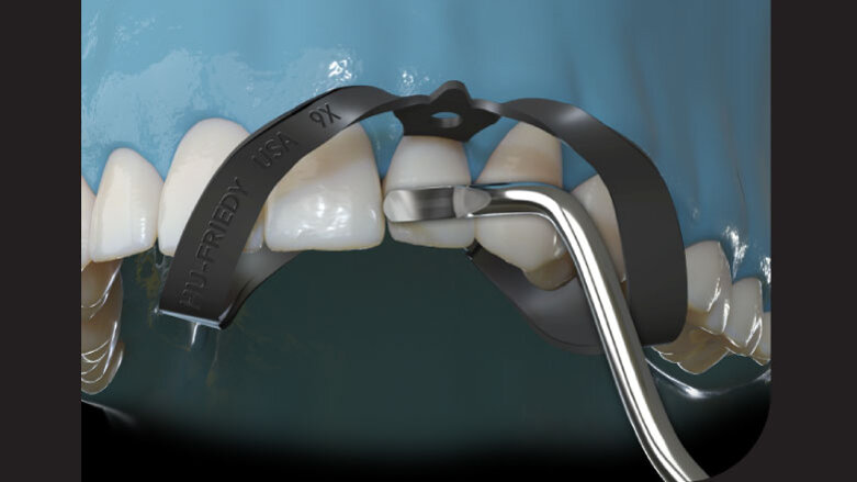 Create Beautiful Restorations with Akro‑Flex™