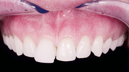 Umění personalizovaného smile designu