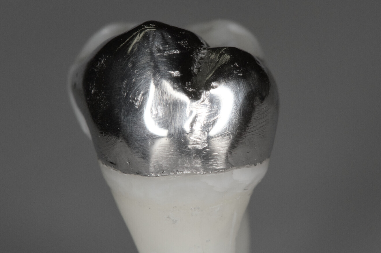 Fig. 8: Cemented onlay.