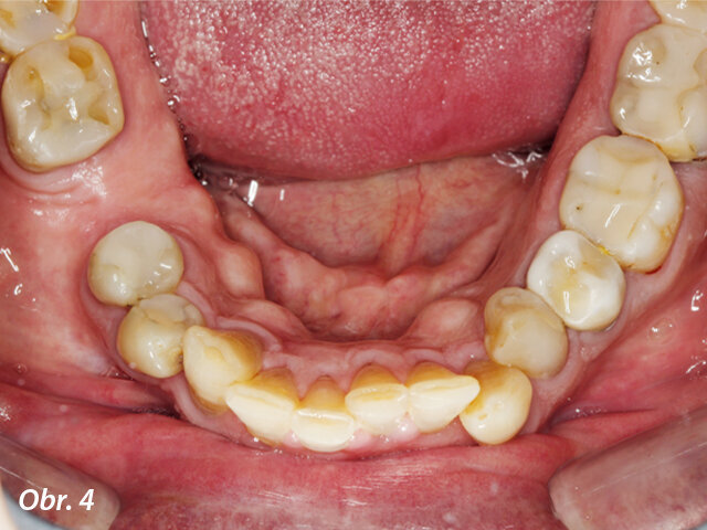 Okluzní pohled na mandibulu.