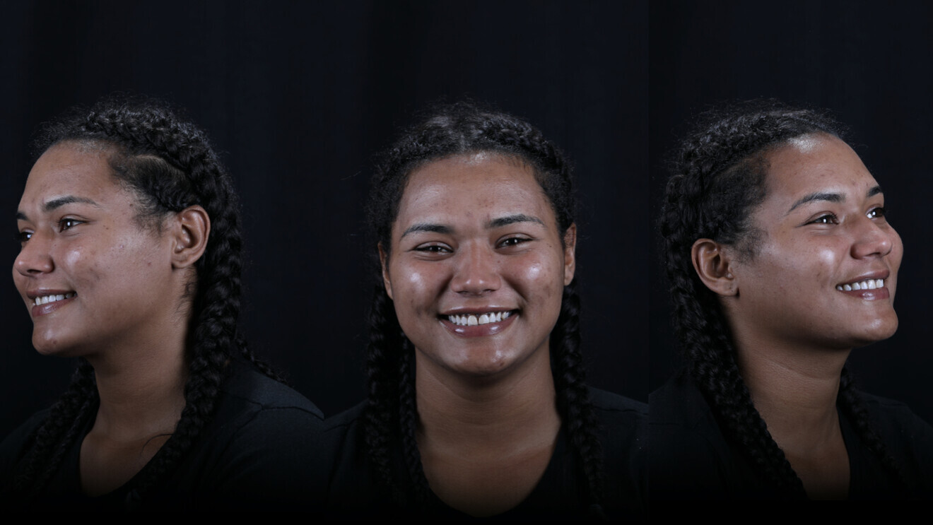 Fig. 10: Pre-op full-face views.