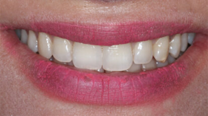 A step-by-step guide to  a direct diastema closure. Case report