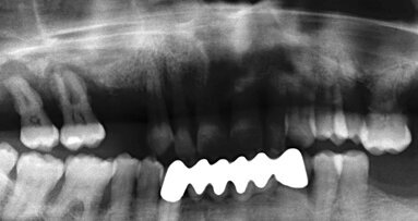 Postupy vertikální kostní augmentace