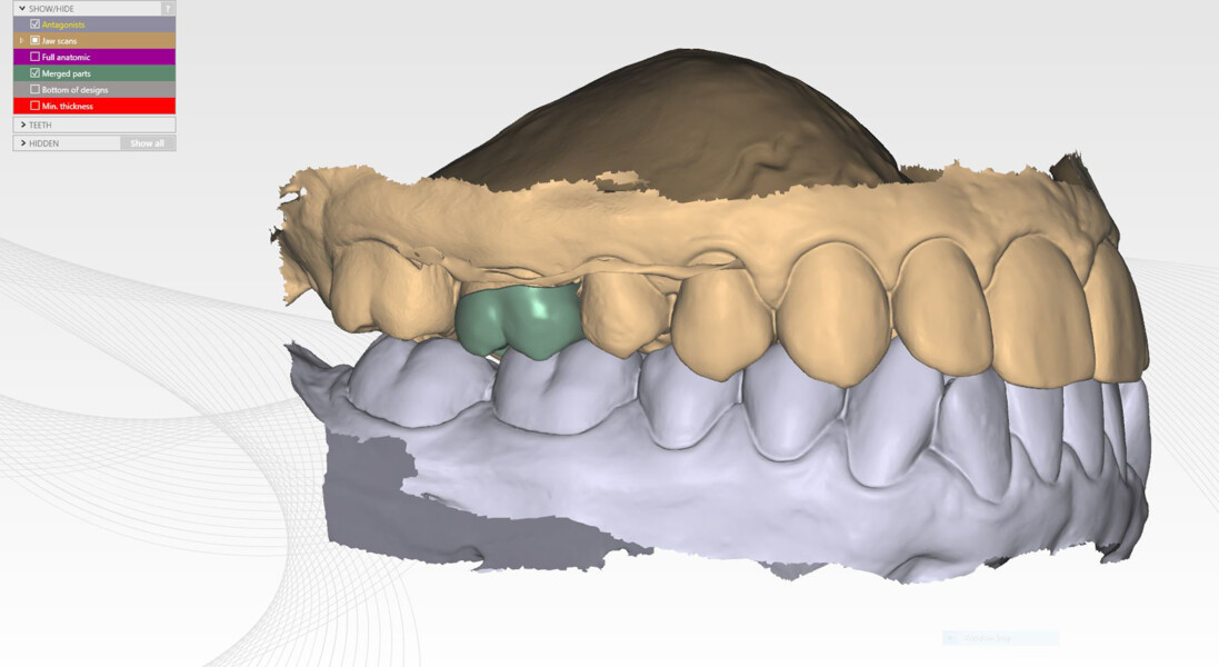 Fig. 17b: Digital workflow for the onlay design. Full-contour onlay visualised on the virtual model in relation to the opposing arch (buccal view).