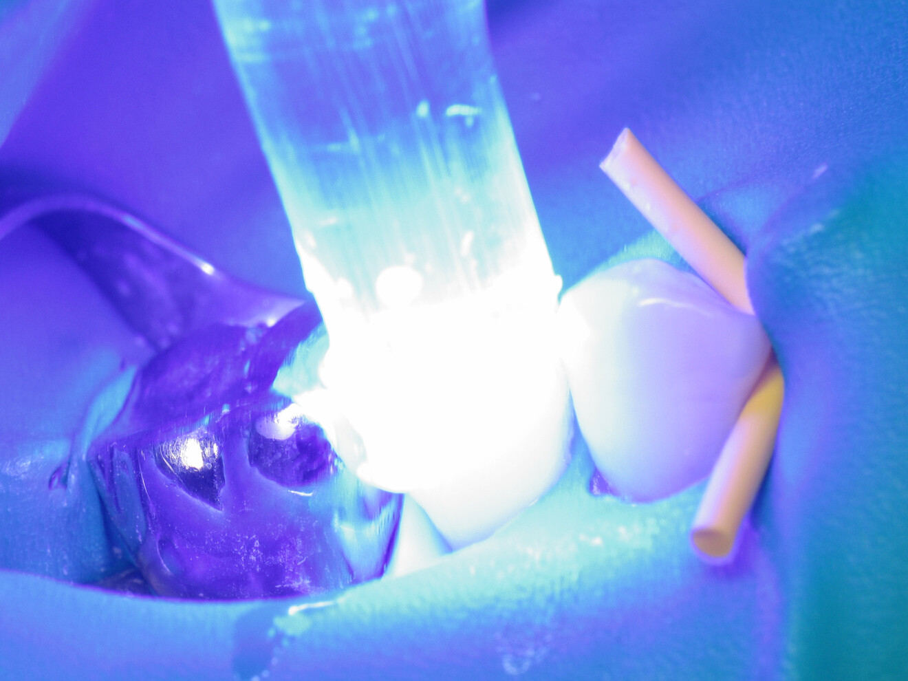 Fig. 18: Light polymerisation through the glycerine.