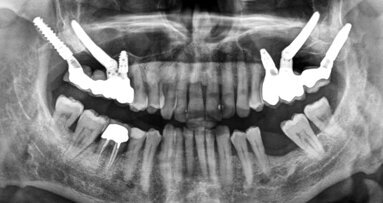 Rehabilitace unilaterální maxilární bezzubosti