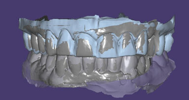 Digital face-bow transfer technique dentofacial analyser for dental aesthetics