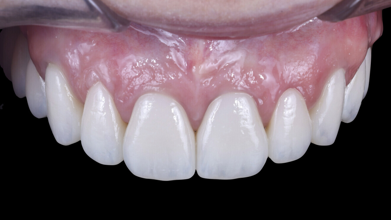 Fig. 35: Definitive restoration in place.