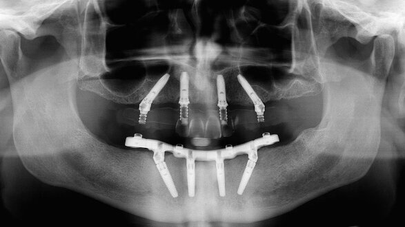 Three-year clinical and radiographic outcomes of patients treated according to the All-on-4 concept in the daily practice: A prospective observational study on implants and prosthesis survival rates and complications