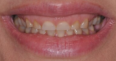 Comprehensive aesthetic transformation: Integrating hard- and soft-tissue treatments using the FotonaSMILE approach