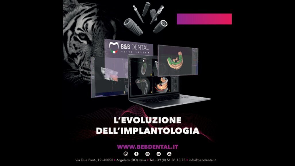 Chirurgia guidata B&B Dental Aspetti pratici e vantaggi