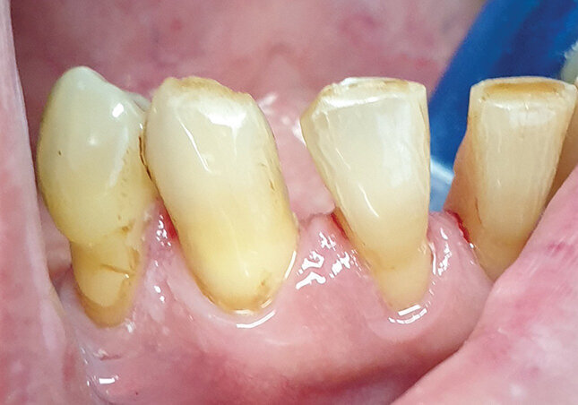 Sl. 2.6: Pacijent B, kontrola nakon 4 meseca od potpunog prestanka pušenja
