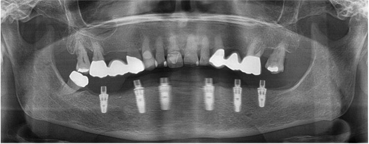 Fig. 10: Post-op panoramic radiograph.