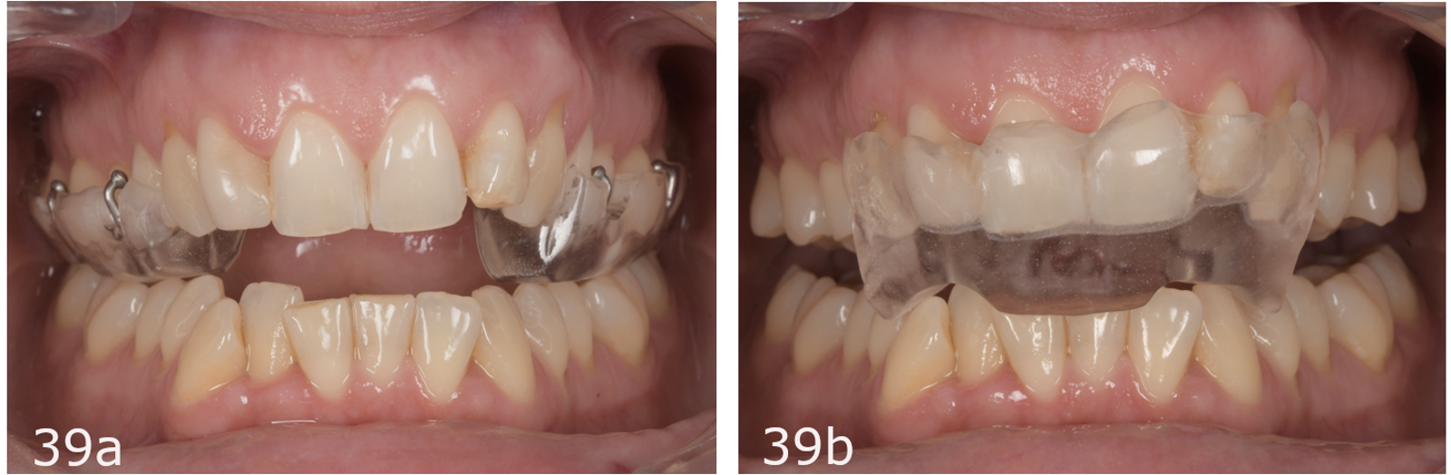 Figs. 39a & b: Two-piece splint.