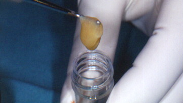 Analiza efektywności czynników wzrostowych zawartych w PRP i Emdogain