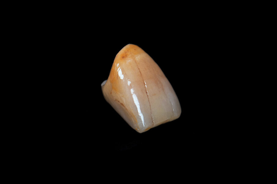 Fig. 7: The final fully ceramic crown has an age-appropriate morphology, surface texture and shading.