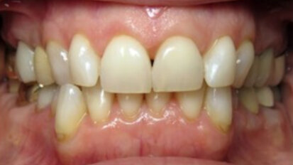 Digital workflows for complex adult aligner treatment