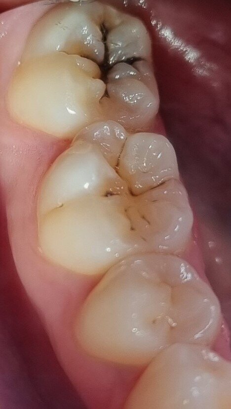 Fig. 1: Non-cavitated carious lesions in teeth #46 and 47. The greyish aspect of the enamel and the hypersensitivity of tooth #47 experienced by the patient suggested an underlying dentine lesion requiring restorative treatment.