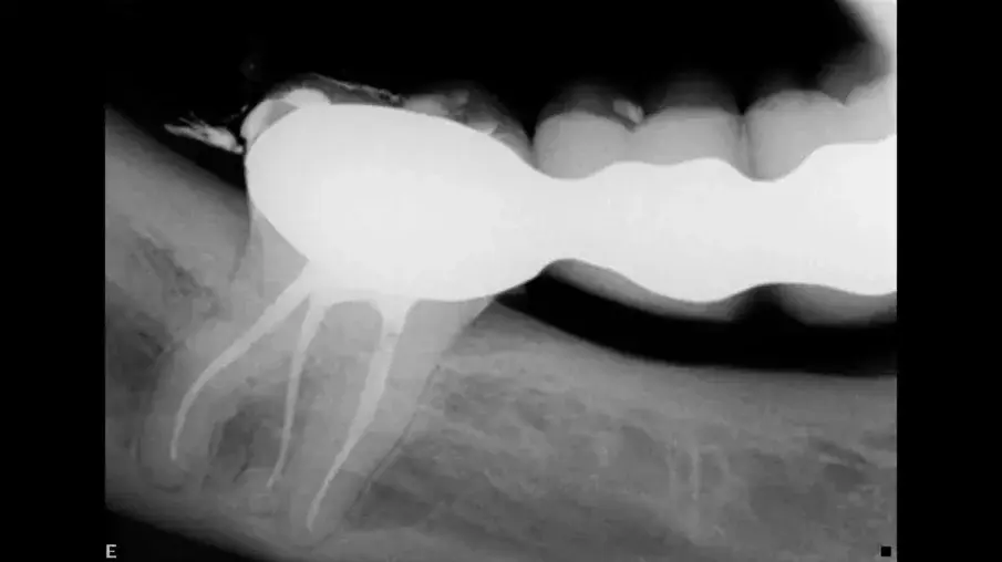 Фиг. 16 Следоперативна рентгенография непосредствено след обтуриране наканалите.