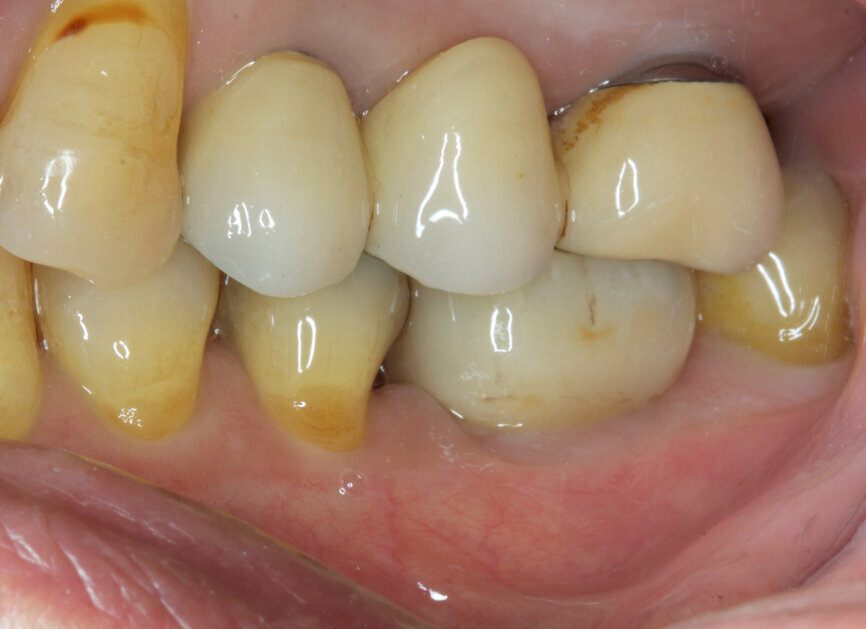 Fig. 19: Temporary crown immediately seated.