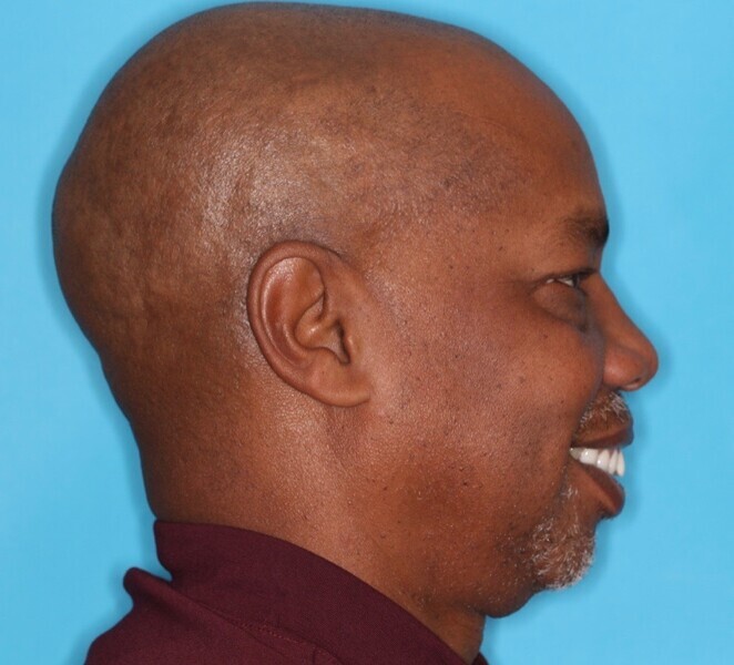 Fig. 4: Right lateral profile view.