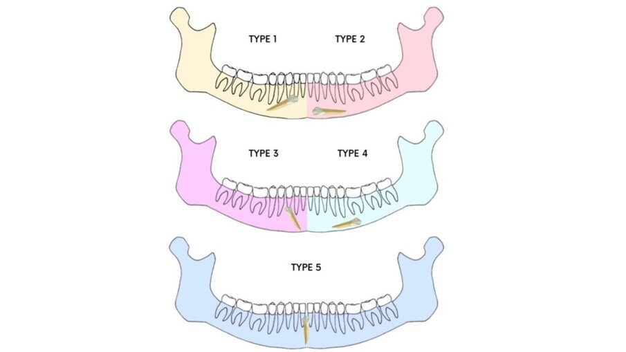 Fig. 1_Classificazione di Mupparapu.