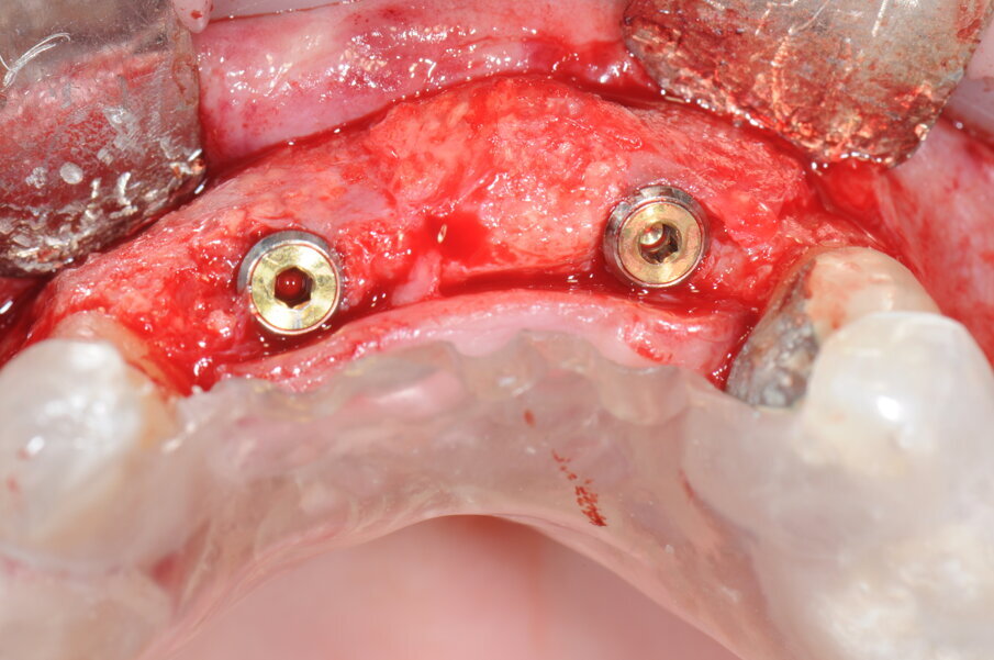 Fig. 18 - Posizionamento delle viti tappo.