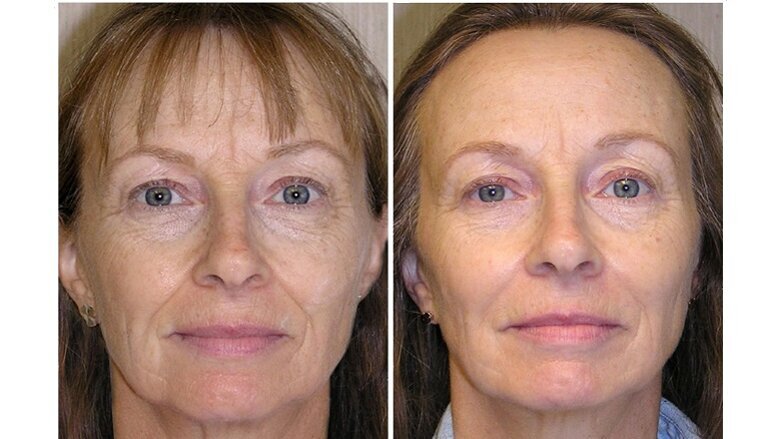 Improving the facial balance in an adult using slow arch development techniques