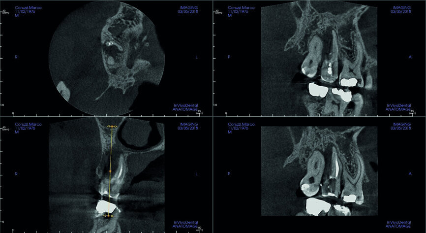 Fig. 7: Pre-op CBCT scan, coronal and sagittal views.