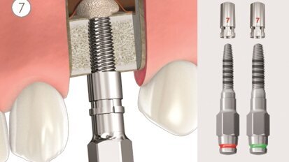 Mini sinus lift (podizanje poda sinusa), krestalni pristup - tehnika duravit crestal sinus lift by B&B DENTAL