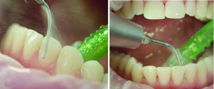 Fig. 10 and 11: Calculus removal from natural teeth with PS attachment by EMS. This very fine instrument allows thorough cleaning even in hard-to-reach areas, below and above the gingiva (up to 10 mm depth). Recommendation: Set the power to 30-60%, water flow to 70-100%.