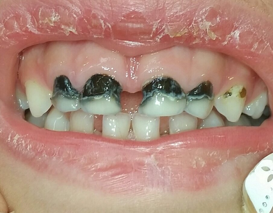 Afbeelding 2b. Zilvernitraat had een cariësremmend effect ondanks de aanwezigheid van plaque.