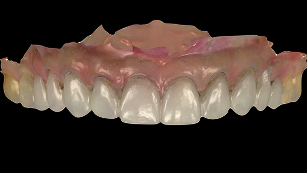 Fig. 12a. Planificación digital de las restauraciones provisionales.