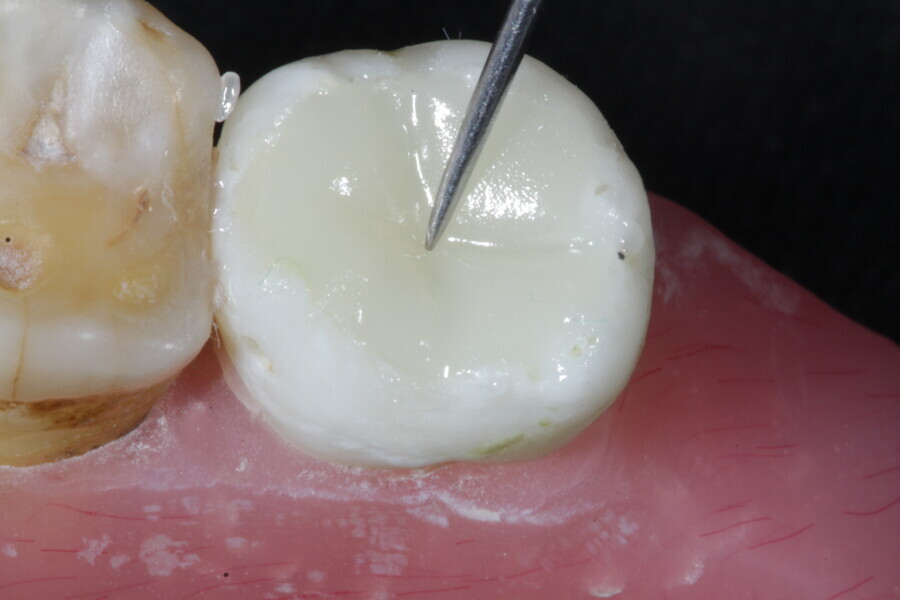 Fig. 31: The final occlusal layer of the restoration is placed using an enamel supra-nano hybrid composite in Shade A2 (Estelite).
