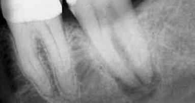 Un suivi de huit ans d’une réimplantation intentionnelle parfaitement réussie