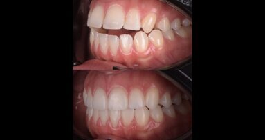 Treating a complex anterior open bite
