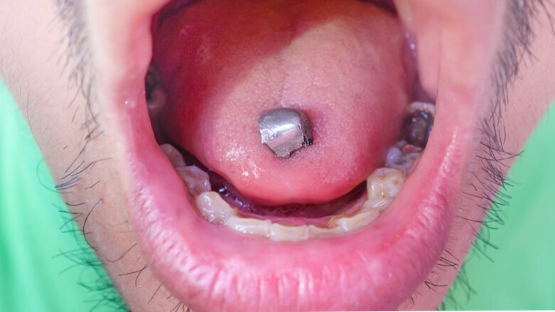 FDA changes stance on dental amalgam