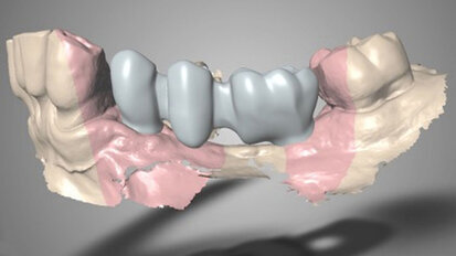 Rehabilitace pomocí kónických implantátů, augmentace kosti a keramického vhojovacího abutmentu