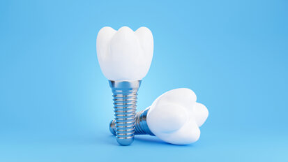 Researchers develop patient-specific dental implants