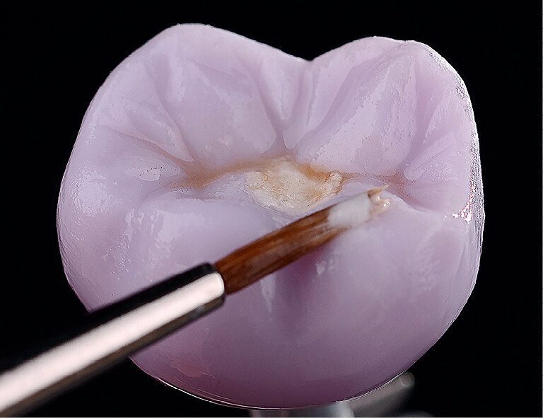 Fig. 32: A monolithic hybrid abutment crown was created on the basis of a Ti base connector using CEREC software. Crystallization and staining were again carried out in a single step.