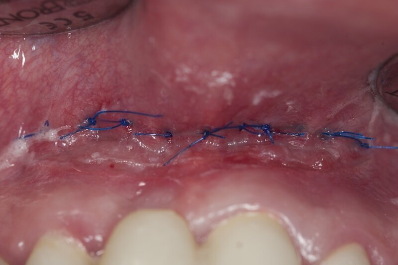 Ryc. 9_Stan 7 dni po zabiegu.