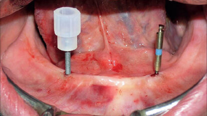 Stabilizace protézy v dolní čelisti – MDI Mini Dentální Implantáty