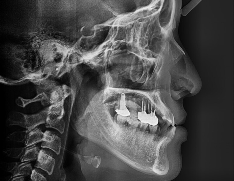 Fig. 4: Initial cephalometric radiograph.