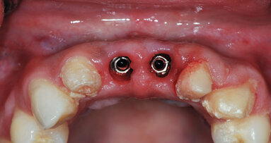 Implant uncovery with the Picasso diode laser