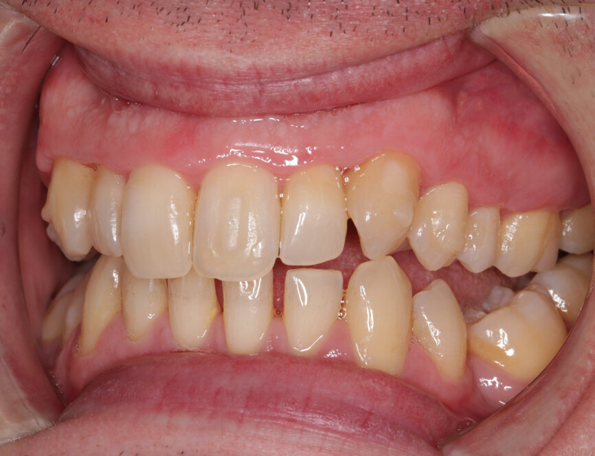 Fig. 11: Post-initial alignment, prior to refinement aligners left lateral view