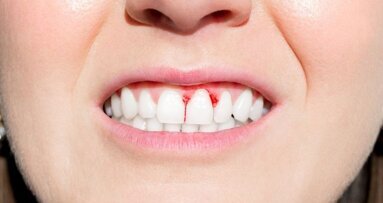 Parodontitis kostte Europa 158,6 miljard euro in 2018