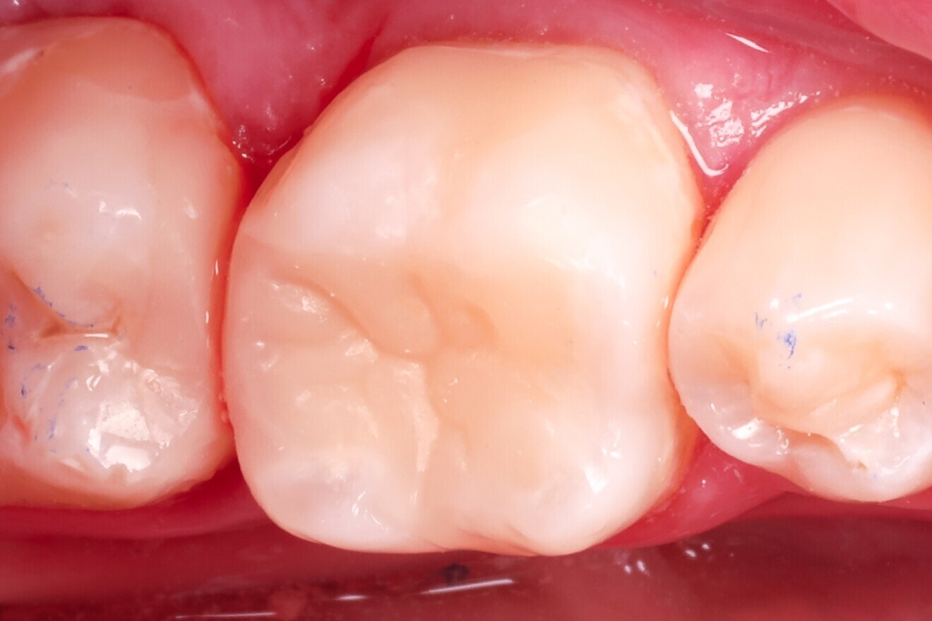 Fig. 26: Occlusal view after final adjustment. 